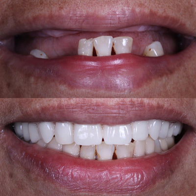 Rehabilitación Oral