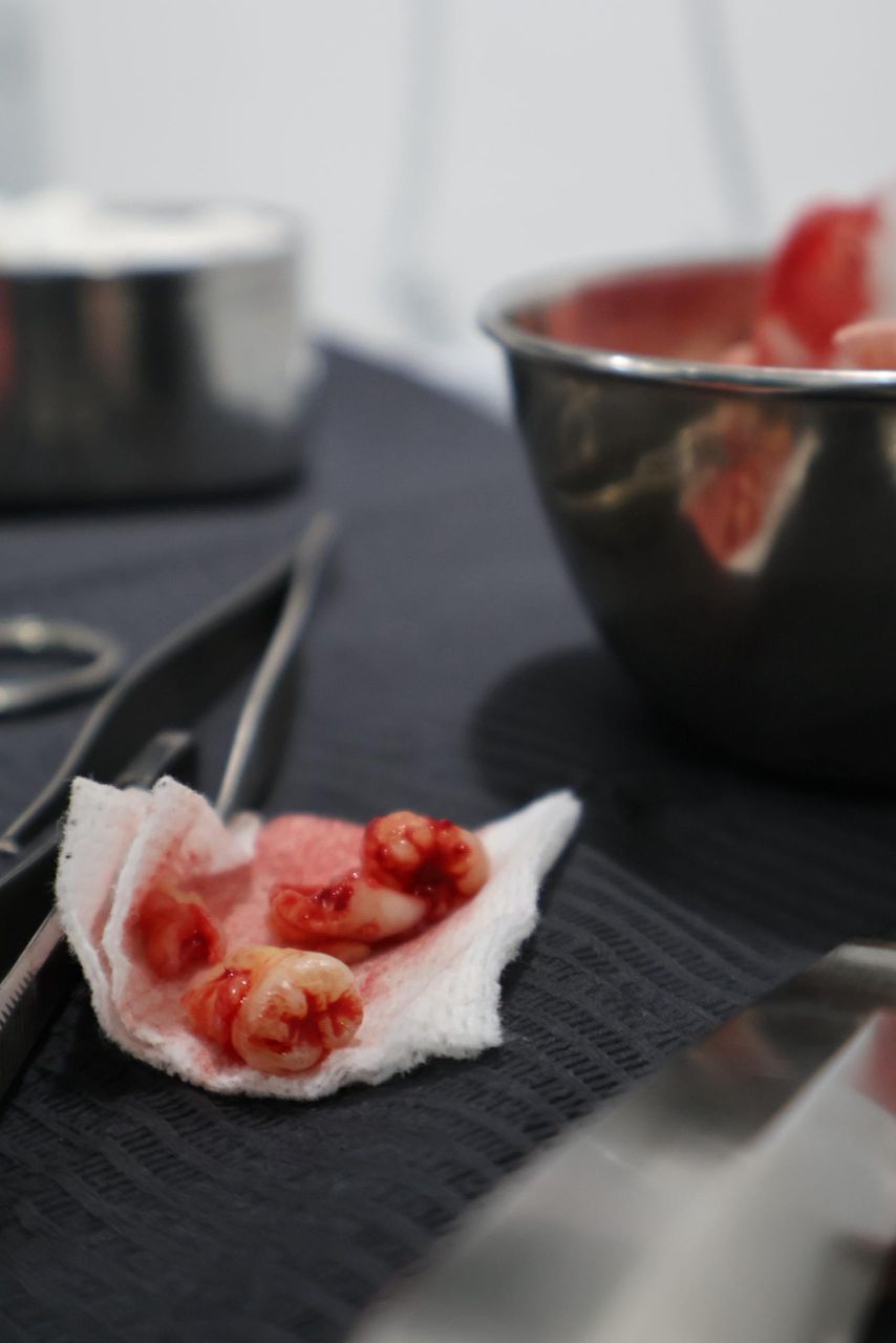 Extracción de cordales