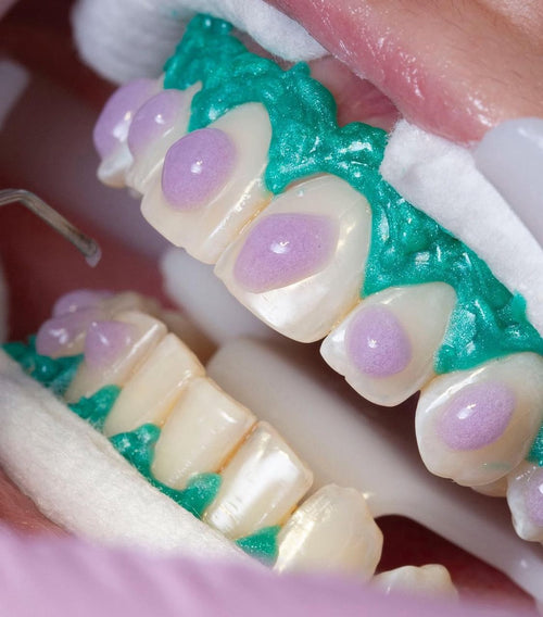 Consulta + Blanqueamiento