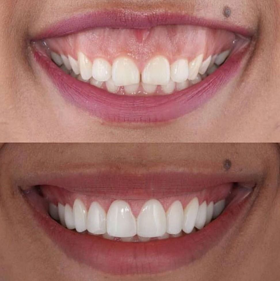 Corte de encía (Gingivoplastia)