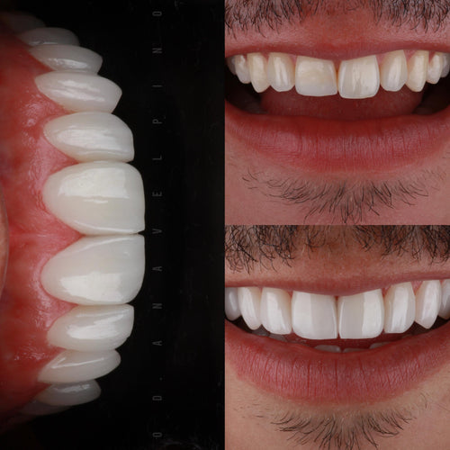 Carillas dentales de resina