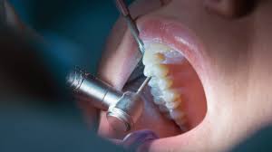 Endodoncia