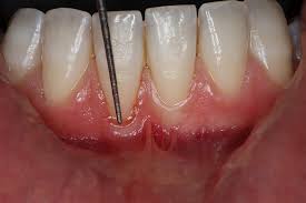 Periodoncia