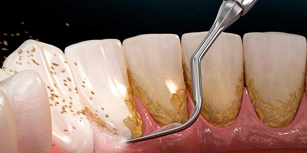 Periodoncia